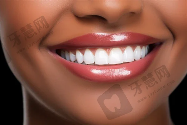 杭州补牙一般多少钱一颗？价格费用？附补牙时的注意事项分析！