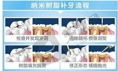 树脂充填术