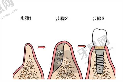 美国3种种植体