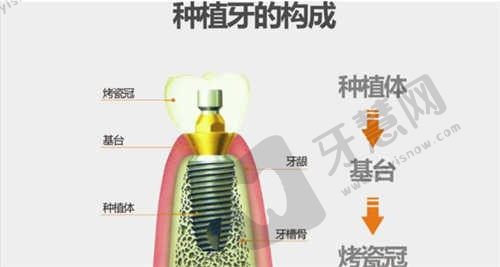 半口种植