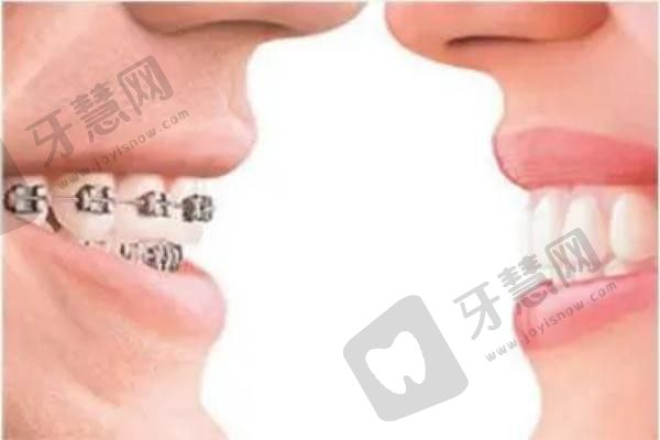 张家口麦格口腔医院矫正牙齿多少钱？7600元起深入了解矫正项目的价格与优势