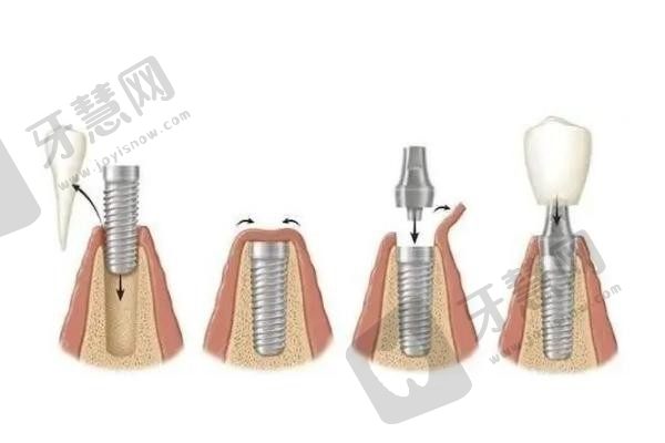 佛山爱顿口腔根管治疗后做牙套价格是680元起/颗，质量有保护还有优惠哦~