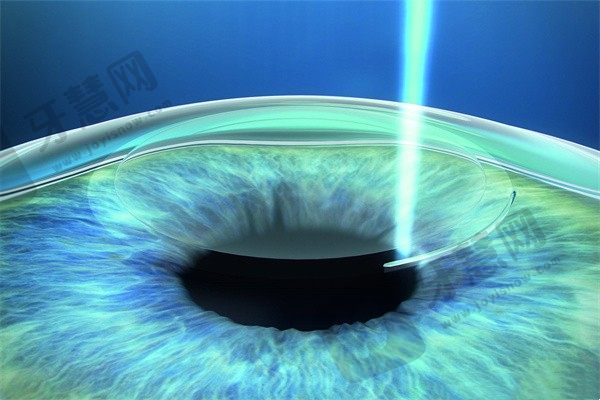 刘苏冰做近视手术怎么样？40年经验23万例手术见证技术超靠谱