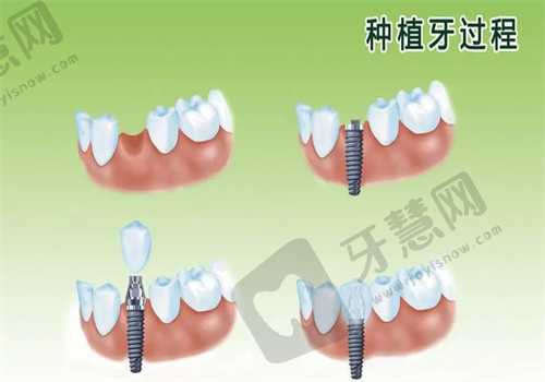 种植牙多少钱一颗2024年价格表