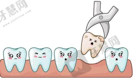 拔牙后多久可以镶牙？镶牙的分类都有哪些？