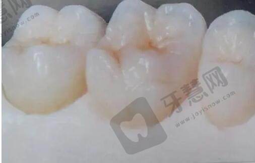 钴铬烤瓷牙齿的使用寿命是多少年?