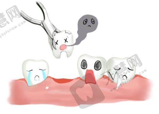 拔牙多少钱一颗牙价格表2023，受到4种因素影响