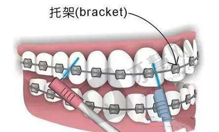 牙齿矫正会松动吗?