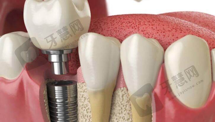 种植牙过程复杂吗?