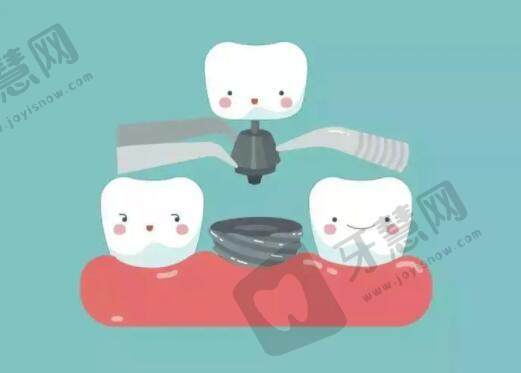 上海市普陀区中心医院口腔科种植牙病例分享