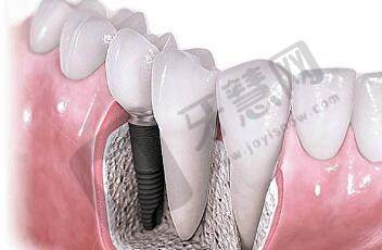 天津市人民医院口腔科种植牙病例