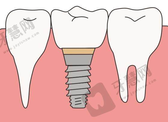 北京中医医院顺义医院口腔科种植牙病例分享