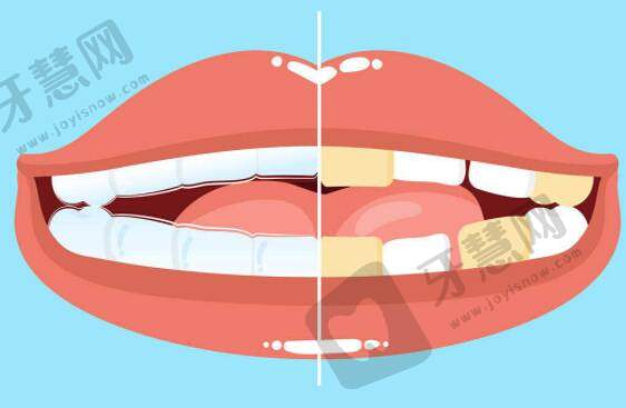 消除牙垢的方法有哪些结果不错？牙垢带来的危害是什么？