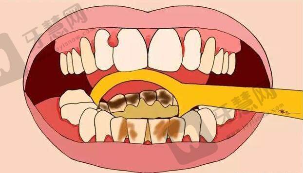 牙垢上的主要成分是什么?