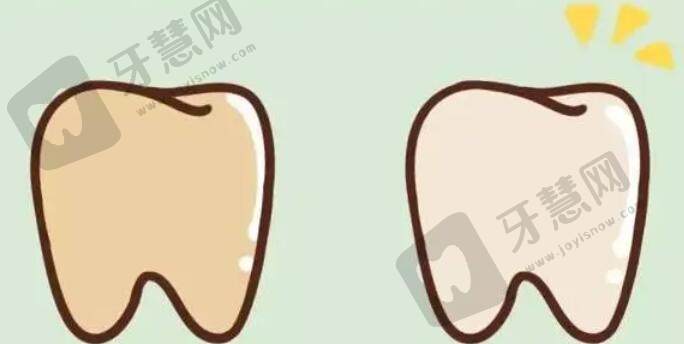 导致黑牙的原因是什么?