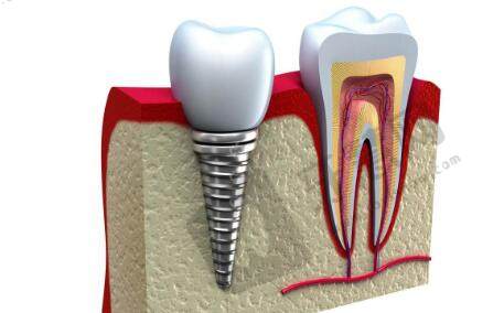 上海长海医院口腔科牙齿种植病例