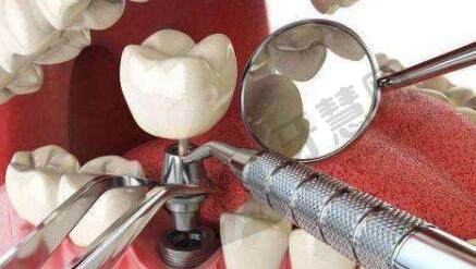 上海芙艾医疗美容诊所牙齿种植多少钱?价格表