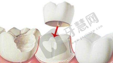 广州烤瓷牙价格表2023，烤瓷牙可以使用多久？怎么护理？