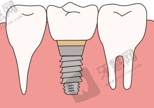 种植牙6.jpg
