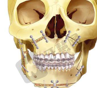 颌面畸形矫正手术