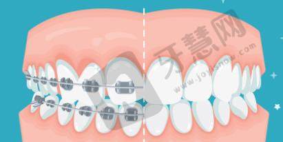 牙齿矫正