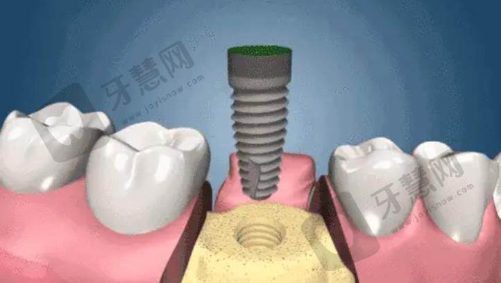常德种植牙多少钱一颗？好大夫、美奥口腔、瑞佳口腔等医院技术介绍！