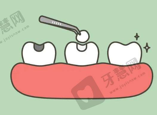 大连补牙一般多少钱一颗？价格费用？ 牙齿缺失后该如何补救！
