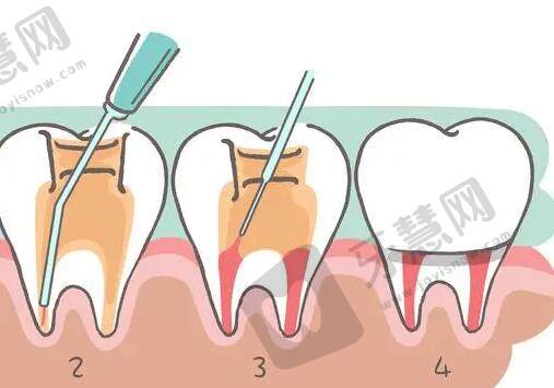 菏泽补牙一般多少钱一颗？价格费用？如何预防牙齿问题呢！