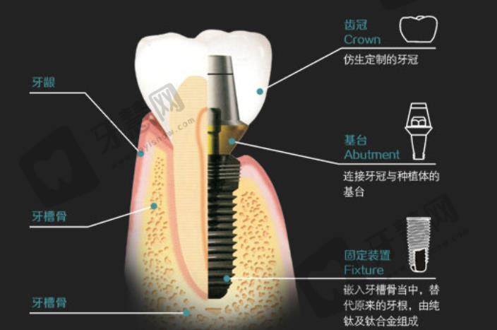 牙齿种植