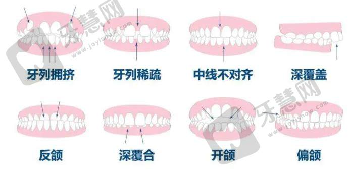 牙齿矫正