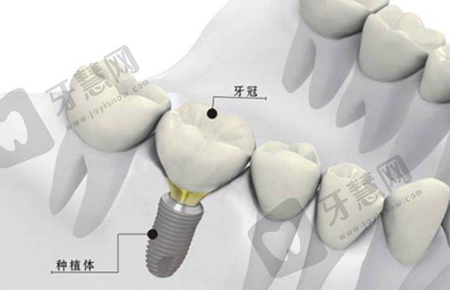 牙齿种植