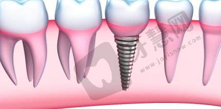 牙齿种植