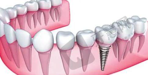 上海芙艾医疗美容诊所种牙怎么样？牙齿种植案例曝光！