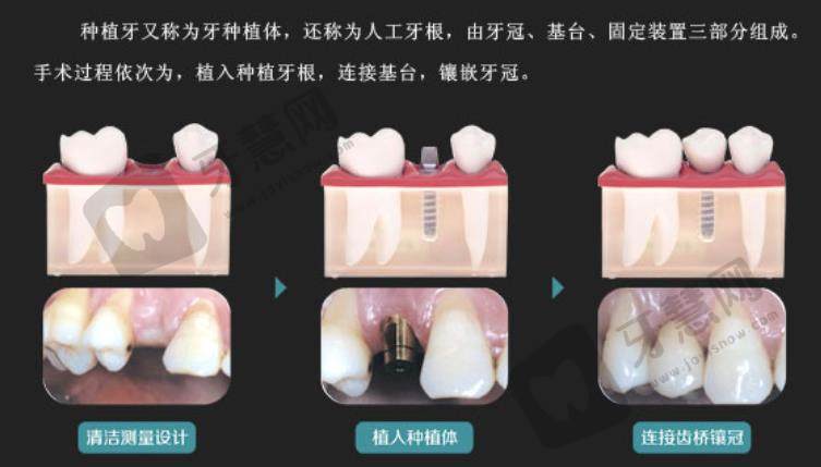 上海芙艾医疗美容诊所种牙怎么样？牙齿种植案例曝光！