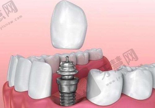 深圳北大医院口腔科种植牙价格多少钱？价格表公布，内附科室、医生资料！
