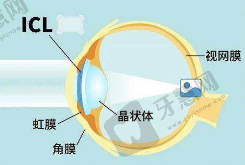 湖北爱尔眼科医院(湖北院区)是正规的吗？正规私立连锁医院全方位解析优质眼科医疗服务