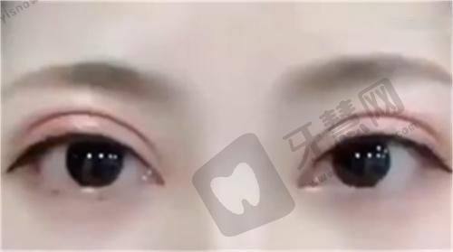 深圳鹏程整形——拉皮去颈纹与面部拉皮结合的医院
