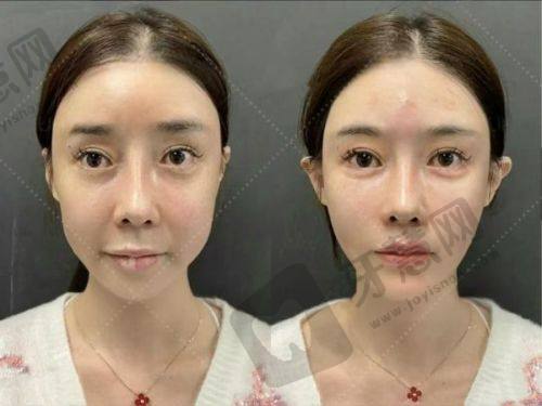 德州整形美容医院双眼皮实例