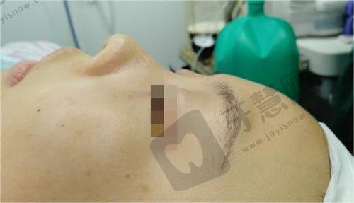 沈阳百嘉丽医疗美容医院：经验多，呵护沈阳玻尿酸垫下巴整形全程