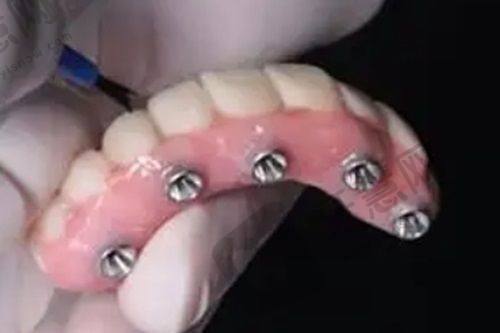 拔智齿好的医院排名之重庆美奥口腔