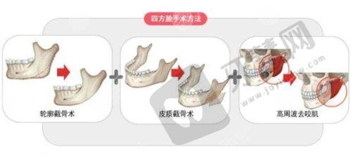 中山大学附属第一医院——皮肤科治疗疤痕疙瘩