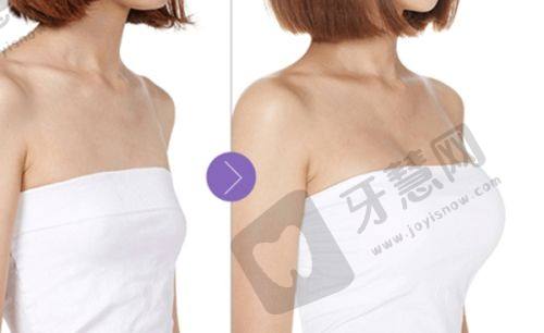 揭秘菲林普利隆鼻：7800 - 20000元价格区间与1 - 2针注射次数详情