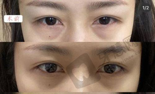 手术前的注意事项:美国viveve薇蜜缩阴手术术前准备