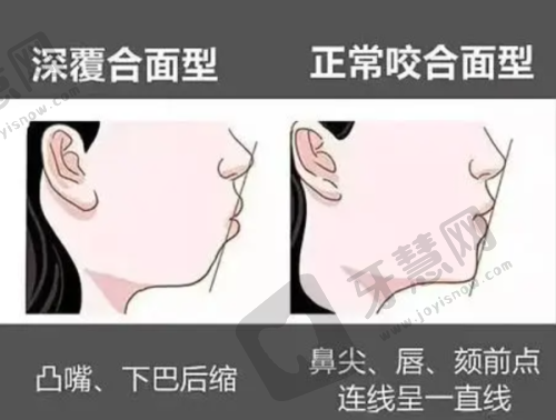 种植牙优势，种牙优选长春叁肆伍口腔