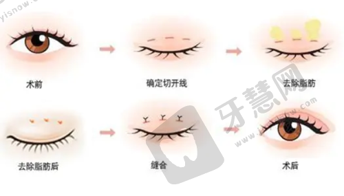 重点介绍陇南禾美整形的双眼皮修复优势