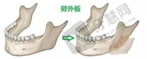 影响疤痕修复手术费用的因素