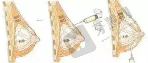 长春超声炮认证医院大揭秘！长春中妍美容医院与吉林铭医整形，附价格表！