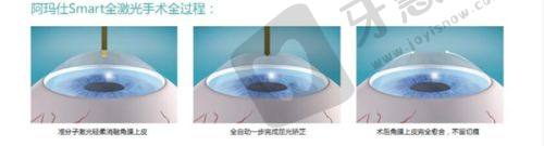 2025年爱尔眼科医院老视手术价格表揭秘