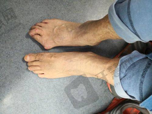 深圳鹏程医院疤痕科注意事项