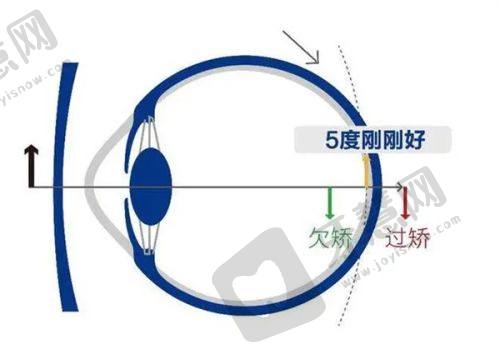 北京茗视光眼科全飞秒手术前后感受与变化